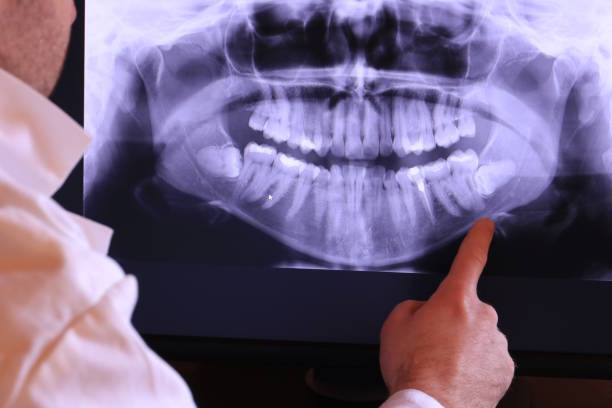 Emergency Dental Filling Replacement in AL