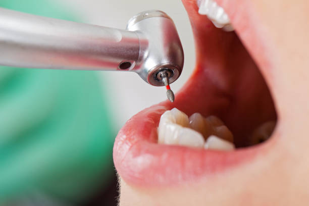 Best Chipped Tooth Repair Near Me  in Demopolis, AL
